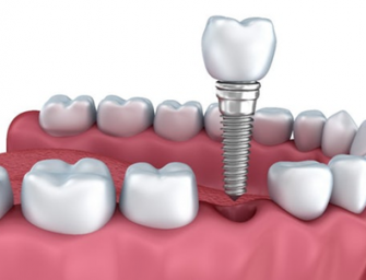 Lucruri foarte interesante despre implanturile dentare
