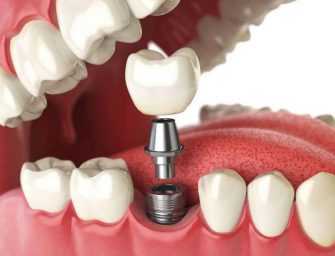 Ce trebuie sa stim despre implanturile dentare?