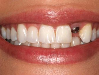 Cat de utile sunt implanturile dentare?